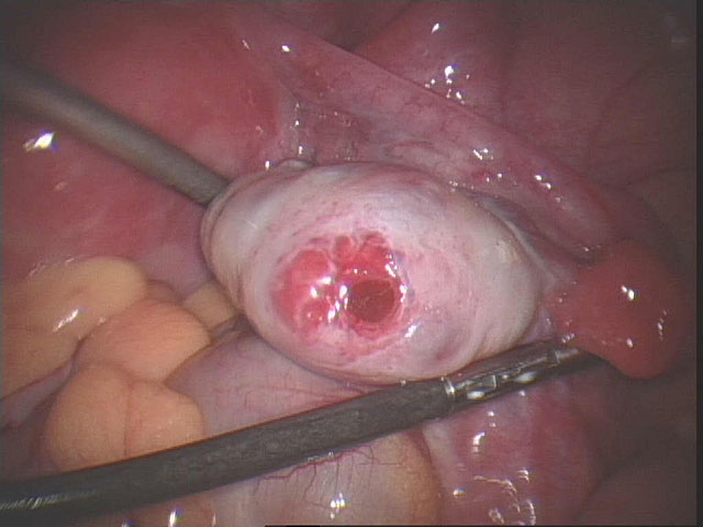 cyst burst cure ovarian cysts page 1711 cyst burst cure ovarian cysts page 1711
